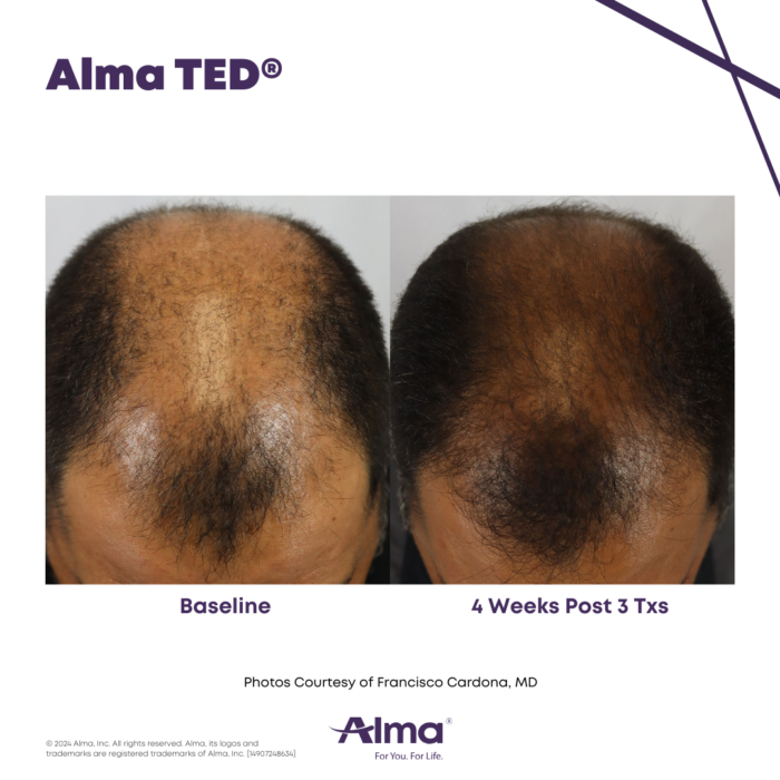 before and after of mans hair growth